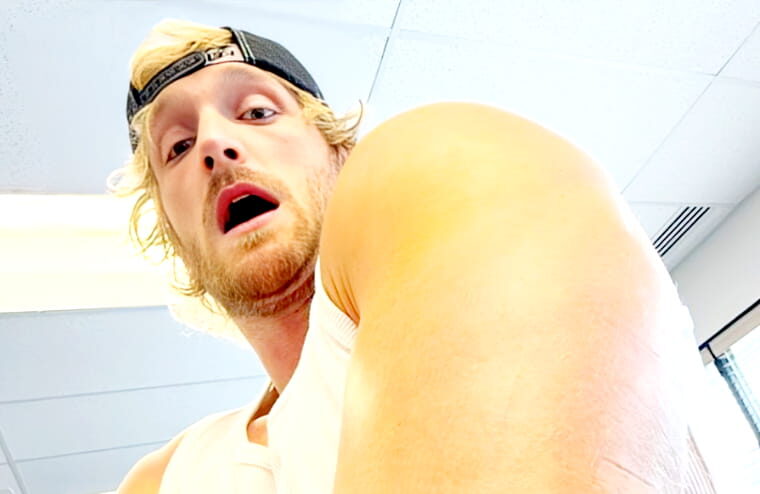 Logan Paul Shows Off Grusome Tricep Surgery Bruising